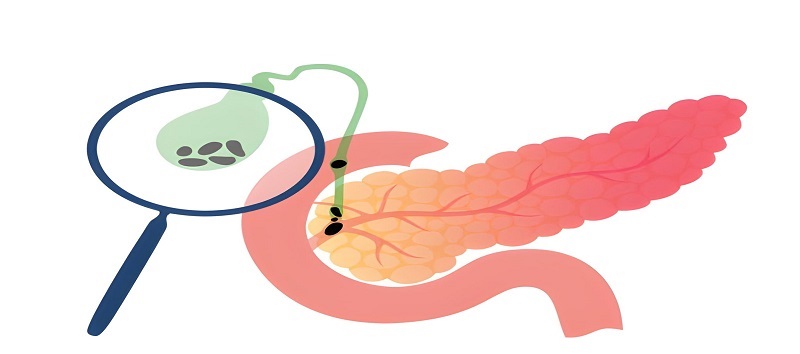Best Gallbladder Stone Treatment in Sakinaka, Andheri